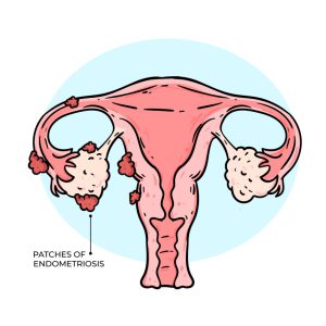Homeopathie en endometriose